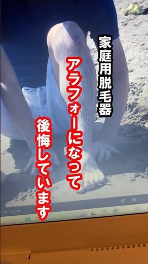 【家庭用脱毛器で脱毛】20代から毛深さに悩んでいました。こんなに効果があるならもっと早く始めればよかったです😭 #メンズ脱毛 #家庭用脱毛器 #脱毛#メンズ美容#アラフォー
