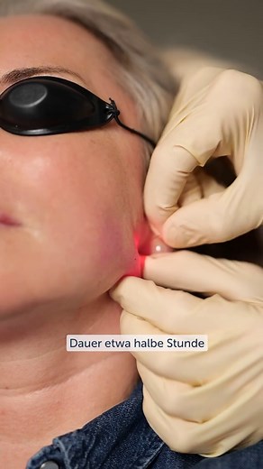 Endolift Behandlung gegen Hängebacken: Natürlich straffere Haut