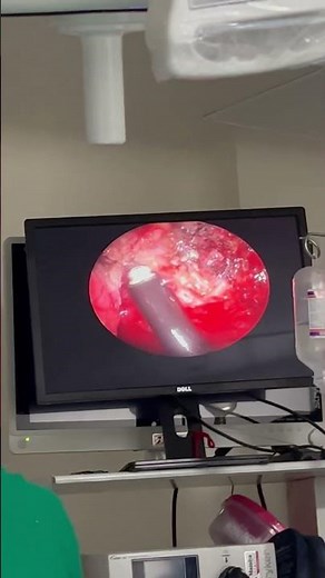 Endoscopic Coblation assisted adenoidectomy