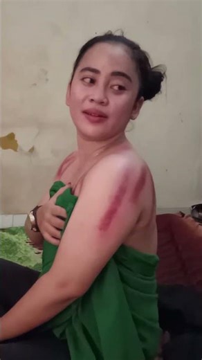 thuong cao gio, cạo gió hotgirl bầm đen chill