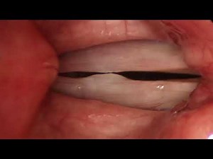 Rigid laryngoscope views of vocal cord margins