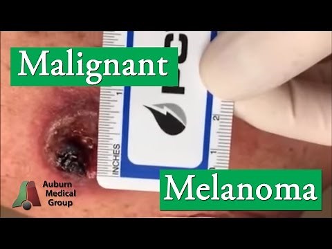 Malignant Melanoma | Auburn Medical Group