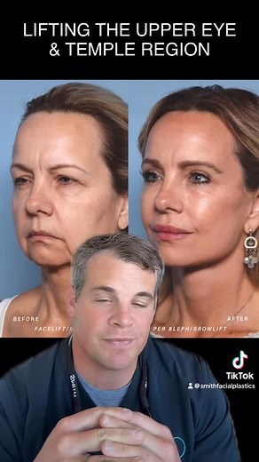 Smith Facial Plastics | Columbus, OH on Instagram: "PART 2. Dr. Scott Smith shares the story behind one of his most talked-about cases — and the importance of lifting the temple region ins some deep plane facelift cases. Tap the link in bio to schedule and to learn more. ____________________________ 📞 614.245.4263 📍 Columbus, Ohio 🌐 smithfacialplastics.com 👤 Facebook: Smith Facial Plastics ▶️ YouTube: smithfacialplastics 🎵 TikTok: smithfacialplastics #columbusohio #facialplasticsurgery #pla