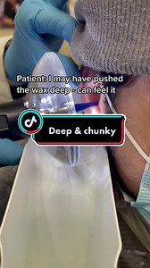 Deep & Chunky Ear Wax Removal in Kingston