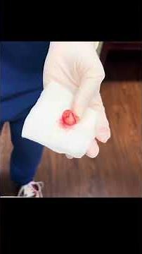 WHATS INSIDE A CYST SAC?