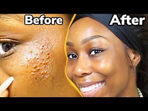 DIY: HOW TO GET RID OF ACNE, BUMPS AND TEXTURED SKIN FAST IN 4 DAYS !!