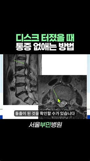 디스크 터졌을 때 통증 없애는 방법