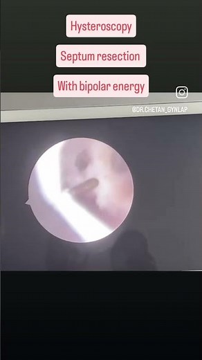 hysteroscopy septum resection bipolar energy saline resectoscope