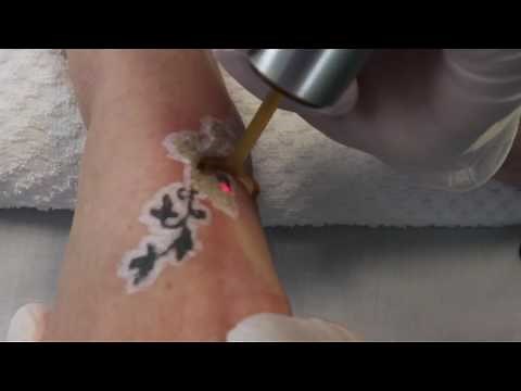 PicoWay Tattoo Removal