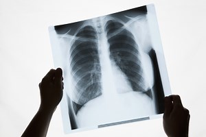 Do X-Rays Increase My Risk of Cancer?