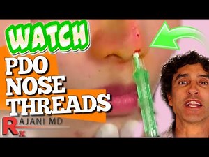 PDO NOSE THREAD LIFT- Non Surgical Nose Job