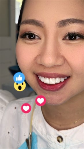 Gum Contouring and Non-Prep Composite Veneers Guide