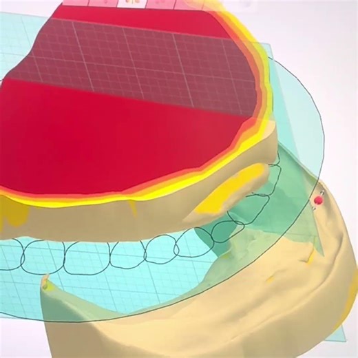 Complete denture design