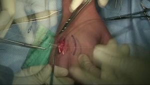 Sagittal Band Reconstruction