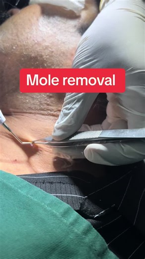 Mole Removal Procedure Explained in Detail