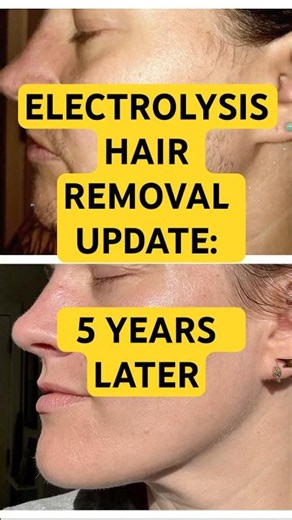 Electrolysis permanent hair removal results for women, men, trans, PCOS, Hirsutism, Unwanted Hair