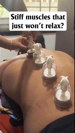 Instant Muscle Tension Release! ⚡ | Clinical Myofascial Cupping #cuppingtherapy #painrelief