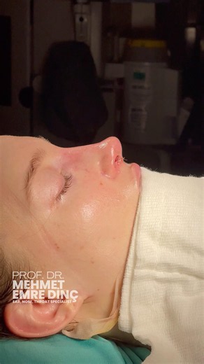 Revision Rhinoplasty, A Natural Change,From USA🇺🇸
