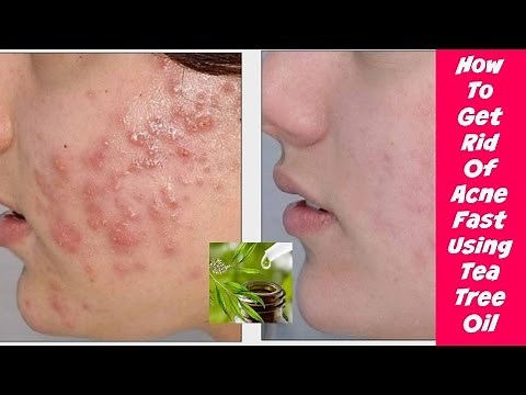 How to Use Tea Tree Oil for Acne.