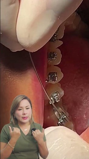 ¿Cómo funciona un cambio de arco en brackets autoligados? 🦷✨