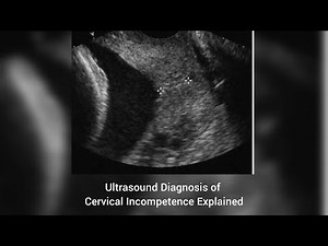 Ultrasound Diagnosis of Cervical Incompetence Explained