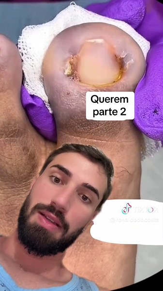 #fyp #ingrowntoenail #foryou #nails