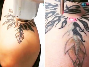7.9M views · 35K shares | This is how laser tattoo removal works. | Insider Tech Presents | Facebook