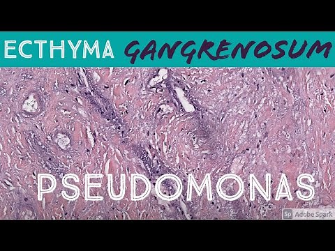Ecthyma Gangrenosum (Pseudomonas aeruginosa) 5-Minute Pathology Pearls Dermatology Dermatopathology