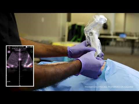 How to Place an Epidural with Accuro's Thoracic Preset [Training Video]
