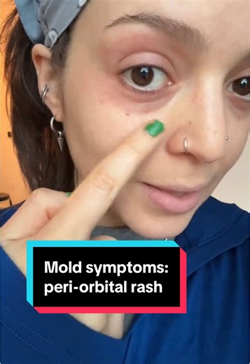 Síntomas del moho: Erupciones peri-orbitales y MCAS