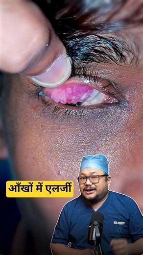 Palak me allergy | giant cell papilloma | Dr Bhanu Pangtey Explain #eyehealth #facts