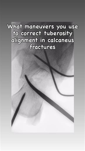 Just Ortho Things on Instagram: "Medial overriding/varus/ translation in axial view are common problems encountered in fixing displaced calcaneal fractures. What manoeuvres you use to correct this malalignment? #.. . . . . . . . . #trauma #ortho #fracture #bone #surgery #orthoworld #doctor #instaortho #femur #hip #foot #ankle #calcaneum #calcaneus #podiatry #injury #fixation"