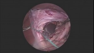 Laparoscopic Nissen Fundoplication