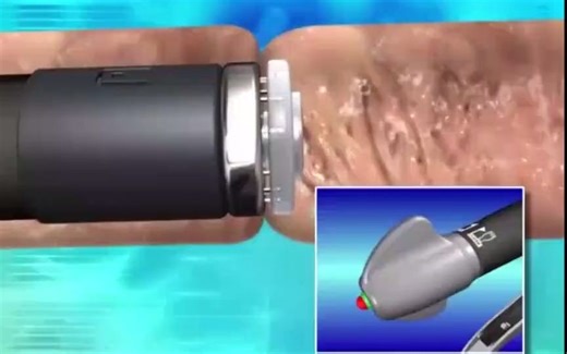 3D医学动画：结肠外科吻合术