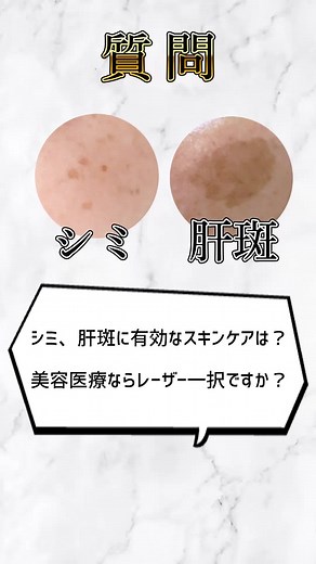 シミや肝斑に効くスキンケアガイド