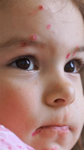 Revisa tu Cartilla Nacional de Vacunación y verifica que cuentes con el esquema completo contra el sarampión. 💉 Si te falta alguna dosis, acude a tu unidad médica más cercana y protégete a ti y a tu familia. La vacunación es una acción preventiva fundamental para evitar brotes y cuidar la salud de todas y todos. | Servicios de Salud de Oaxaca