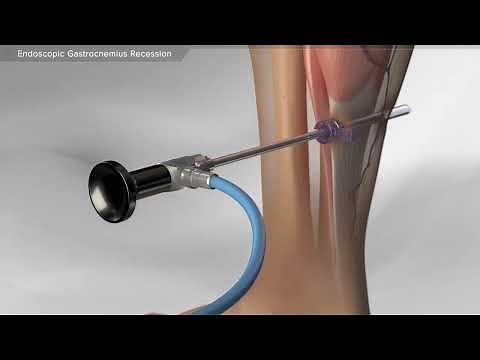 Endoscopic Gastrocnemius Recession