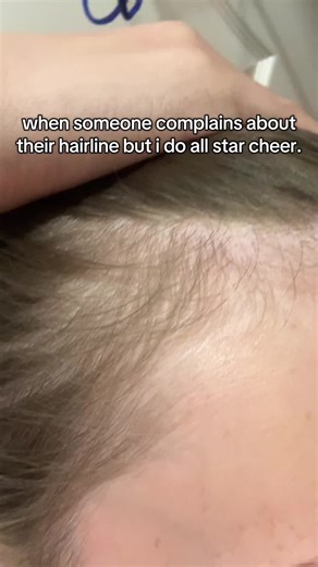 Hairline Woes: The Impact of High Ponytails in Cheerleading