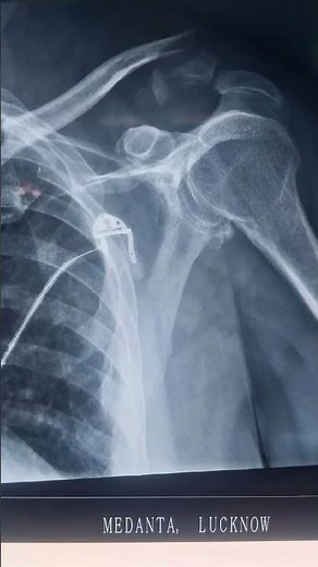 AC joint surgery /Adjustable loop with open button use 🧭🧭🧭🏥🏥🏥🏥