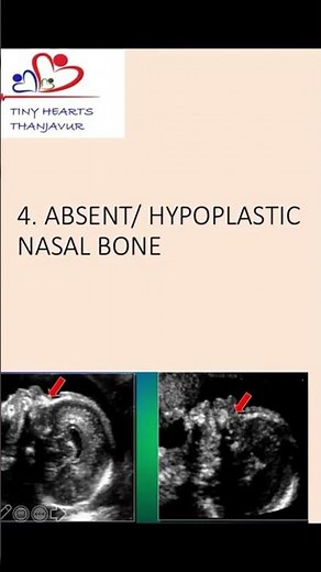 Absent or hypoplastic nasal bone an antenatal scan #nasalbone #hypoplasticnasalbone