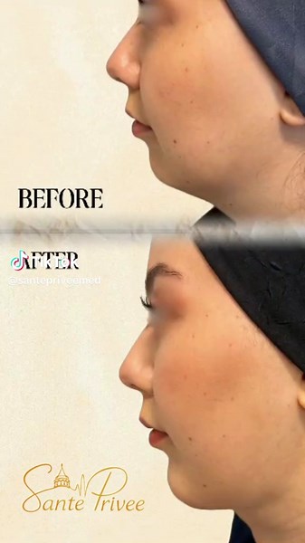 Neck Lift Surgery is not only about improving your appearance, it is a special process that reshapes the aesthetic harmony of your facial contours. ✨ Before: ● Loosening and sagging in the neck area ● Wrinkles and fine lines on the skin ● Aesthetic imbalance between the face and neck line After: ● A firmer, more youthful neck contour ● Refreshed and smoother skin appearance ● Aesthetic harmony with facial features Benefits of Neck Lift Surgery: ● Natural and balanced results with a personalized 
