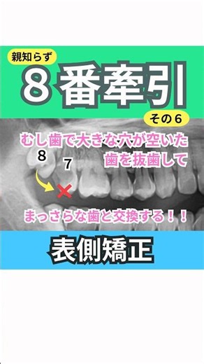 虫歯の大きな歯を抜歯してすぐ後ろのまっさらな親知らずをもってくる矯正症例動画です。 #矯正歯科 #親知らず #thirdmolar #矯正症例 #叢生