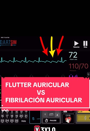 Flutter auricular vs Fibrilación Auricular #flutterauricular #fibrilacionauricular #electrocardiograma