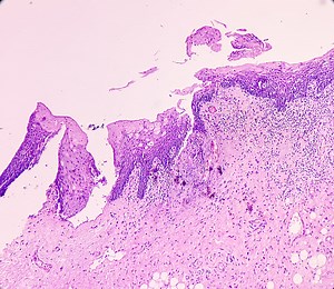 Zunge mit Unterkieferkrebs, Mundkrebs, Invasives...