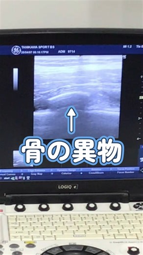 たにかわ運動器・接骨治療院 on Instagram: "骨に異物が「痛む！」原因はこれ #異所性骨化 #骨化性筋炎 #足の痛み #原因不明 #痛み #大腿骨 #太もも #筋肉 #骨 #前もも #エコー #画像検査 #たにかわスポーツ疾患研究室 #サッカー #陸上 #走り#高校生"