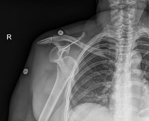 Diagnosis and Treatment of an Anterior Shoulder Dislocation with Bedside Ultrasound - JETem