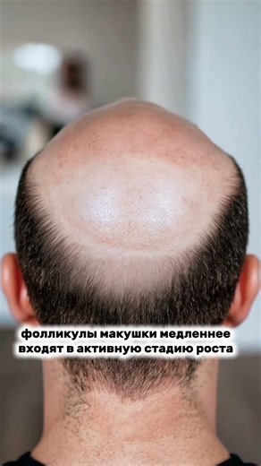 ПОЧЕМУ НА МАКУШКЕ ВОЛОСЫ ПОСЛЕ ПЕРЕСАДКИ ВОЛОС РАСТУТ МЕДЛЕНЕЕ?