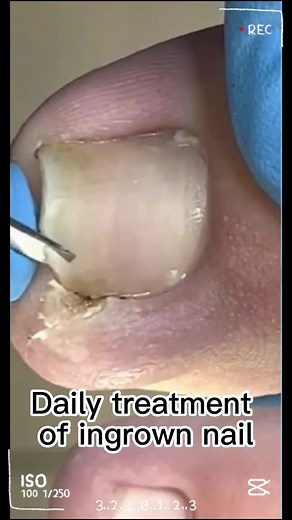 Toenail Treatment: Addressing Infected Toenails Safely