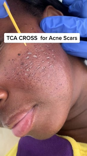 TCA CROSS (Chemical Reconstruction Of Skin Scars) is a procedure to diminish acne scars by carefully placing small amounts of high concentration TCA onto the surface of atrophic scars. This leads to stimulation of new collagen in the depressed areas.🙌 #acnescars #tcacross #chemicalpeel #fyp #skinofcolor #acnescartreatment #derm #icepickscars #skincaretips #skintok