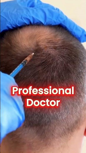 Cheap Hair Transplant Can Cost You More | Avoid Graft Loss & Fake Hairlines | HHC Delhi